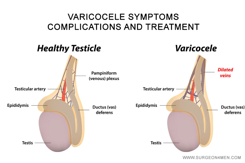 Varicocele Image