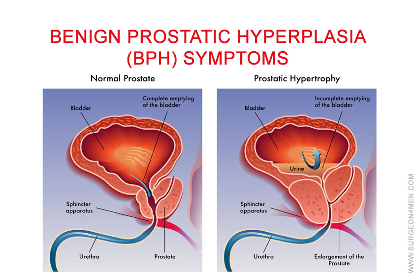Benign Prostatic Hyperplasia (BPH) Symptoms Image