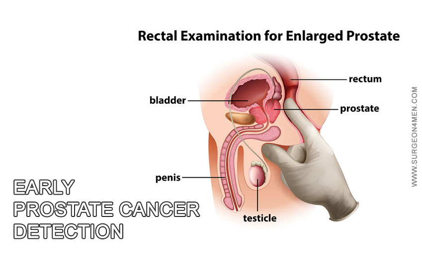 Early Prostate Cancer Detection Image