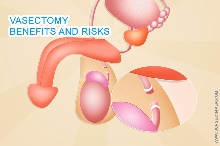 Vasectomy | Benefits and Risks