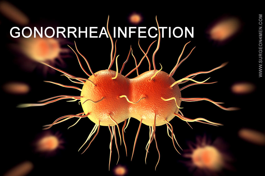 Gonorrhea Infection Image