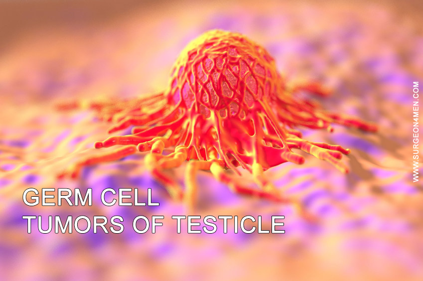 Germ cell Tumors of Testicle Image
