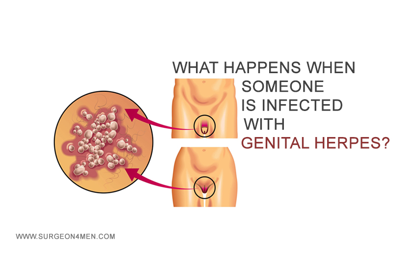 What happens when someone is infected with genital herpes? image