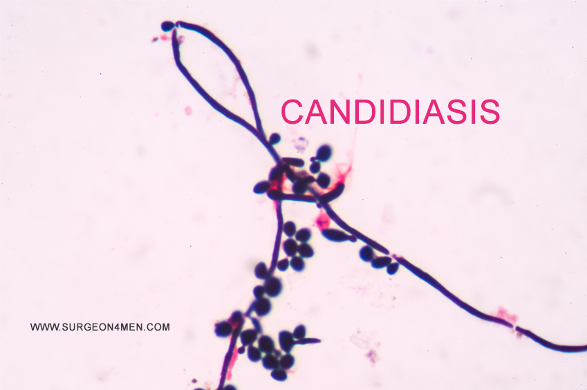 Candidiasis image