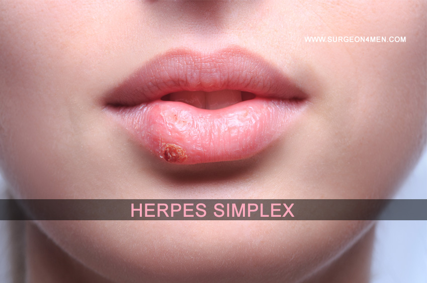 Herpes Simplex image