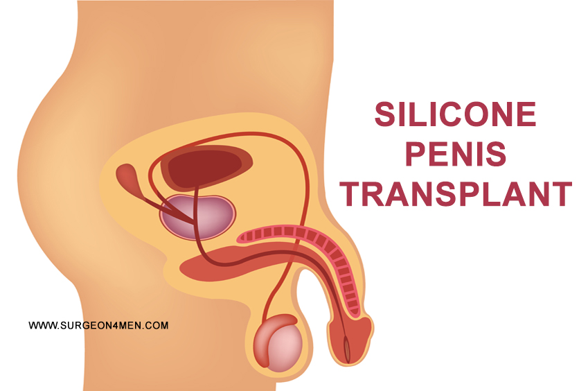 Silicone Penis Transplant image