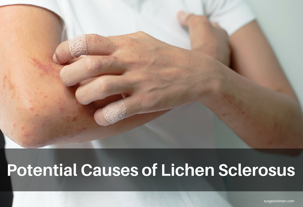 Potential Causes of Lichen Sclerosus