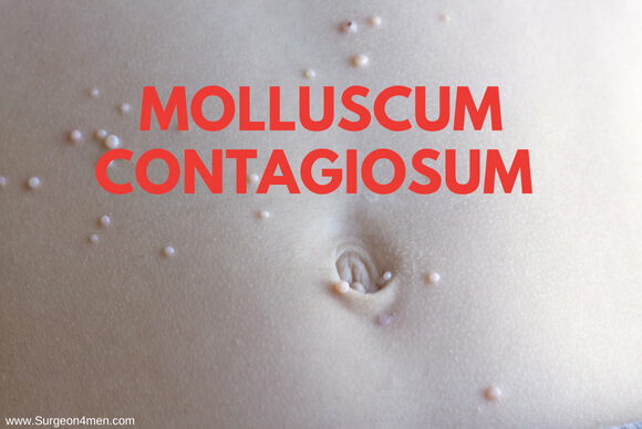 Molluscum Contagiosum