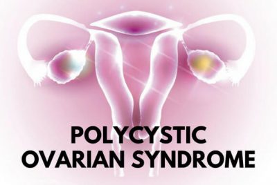 Polycystic Ovarian Syndrome